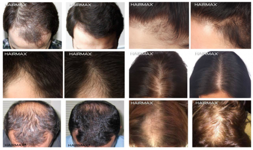 生发仪品牌排名遥遥领先的Hairmax,助你与“秃顶之困”和解